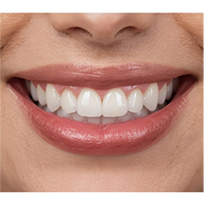 Dental Implant After